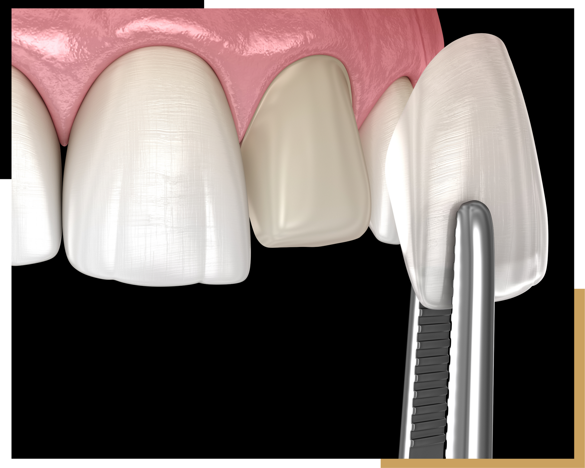 Custom Smile Design Services in Jacksonville | Cre8 Smile Studio